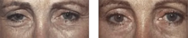 Trattamento con filler